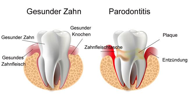 Parodontitis Behandlung Wien